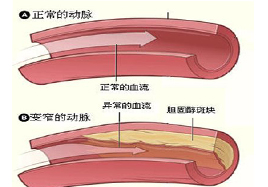 有了動脈粥樣硬化怎么辦