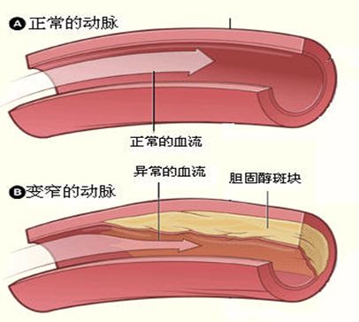 動脈粥樣硬化補硒