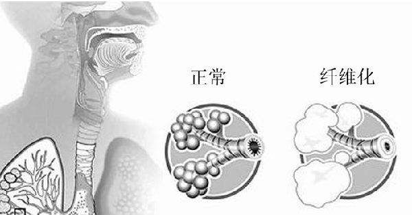 肺纖維化對(duì)比圖